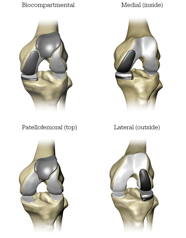 Mako Robotic-Arm Assisted partial knee replacement