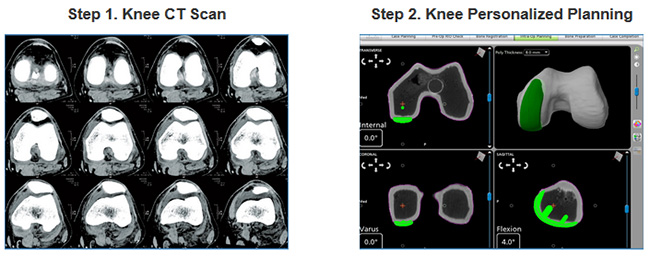 Mako Robotic-Arm Assisted partial knee replacement