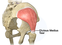 Gluteus Medius Tear