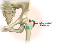 Hip Bursitis