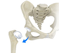 Hip Dislocation