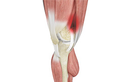 Iliotibial Band Syndrome