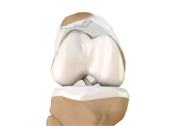 Lateral Patellar Compression Syndrome