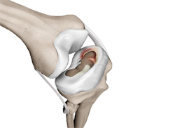 Meniscal Injuries