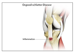 Osgood Schlatter Disease