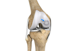 Osteochondritis Dissecans