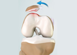 Patellar Dislocation