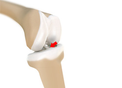 Tibial Eminence Spine Avulsions